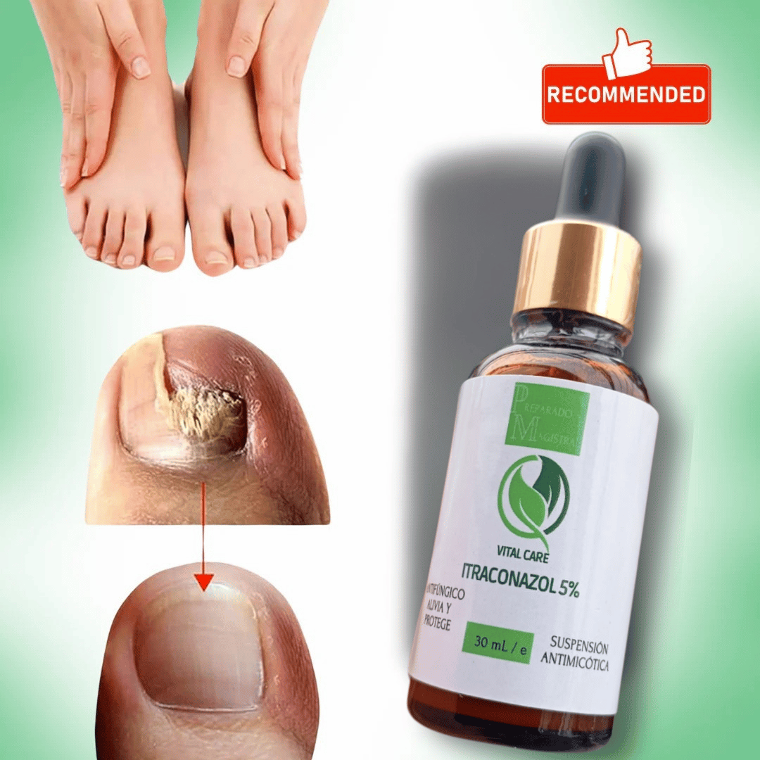 ITRACONAZOL AL 5%-PARA ELIMINAR HONGOS EN UÑAS