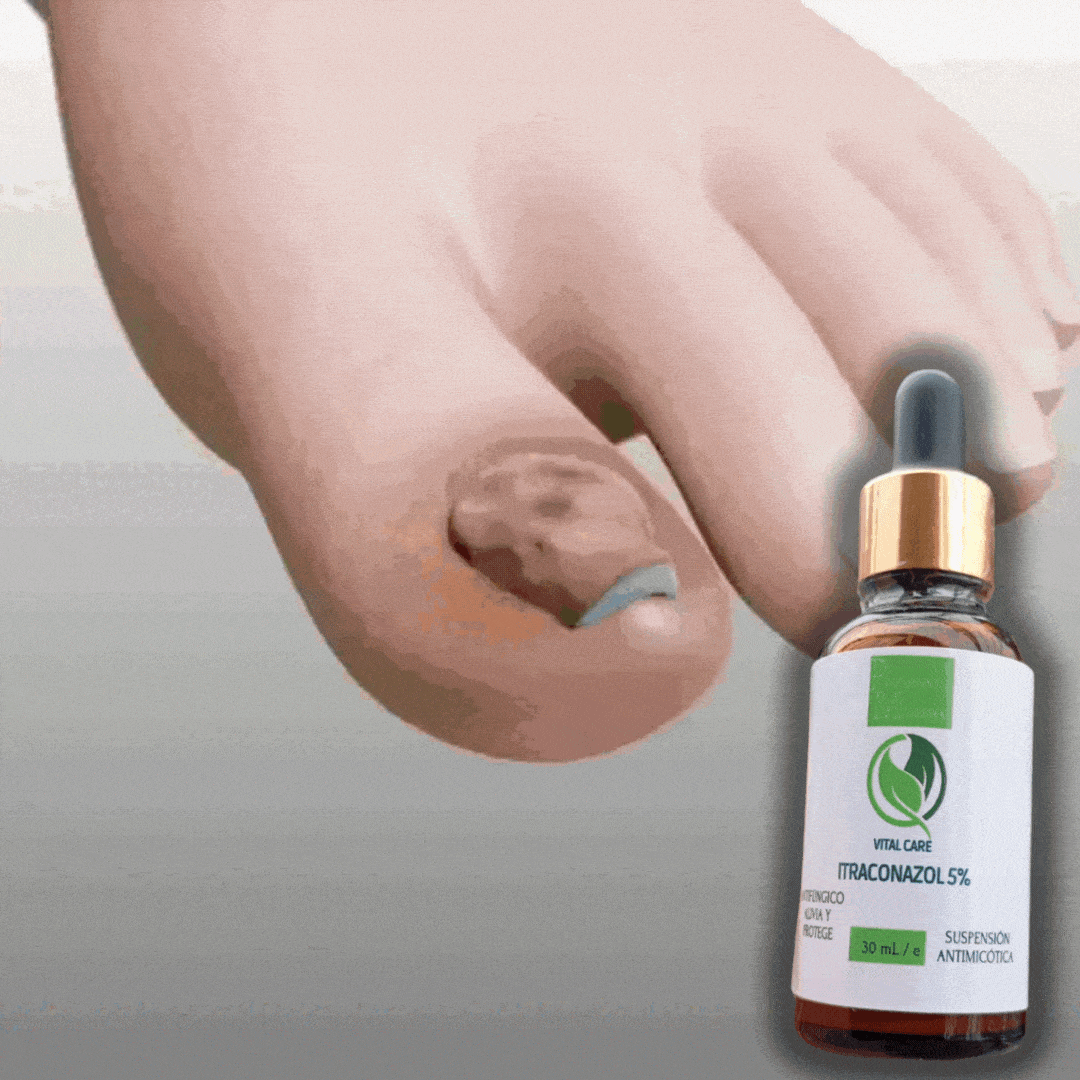 ITRACONAZOL AL 5%-PARA ELIMINAR HONGOS EN UÑAS
